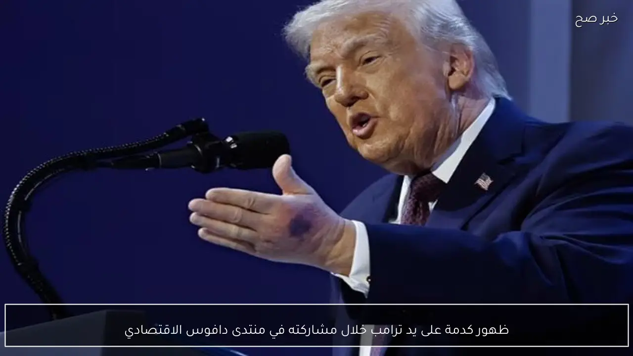 ظهور كدمة على يد ترامب خلال مشاركته في منتدى دافوس الاقتصادي